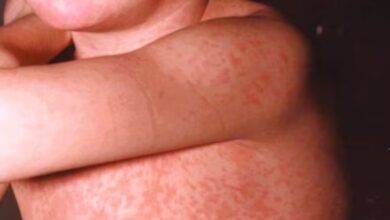 Photo of Sarampión: alerta la OMS sobre un incremento de los brotes en países declarados libres de la enfermedad