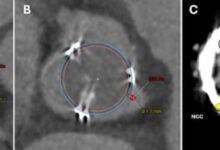 Photo of Realizan con éxito el primer bypass coronario mínimamente invasivo sin abrir el tórax