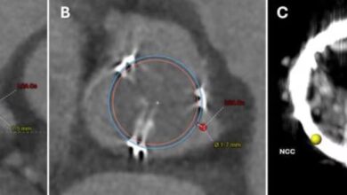Photo of Realizan con éxito el primer bypass coronario mínimamente invasivo sin abrir el tórax