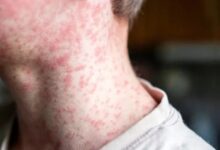 Photo of Se confirma el primer caso de sarampión del año en Argentina