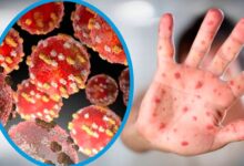 Photo of Registran en Argentina el primer caso de la cepa más agresiva y contagiosa de la “viruela del mono”