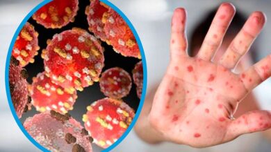 Photo of Registran en Argentina el primer caso de la cepa más agresiva y contagiosa de la “viruela del mono”